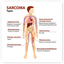 diagram-sarcoma